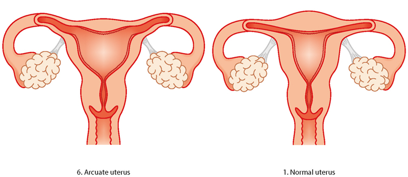 arcuate uterus illustration