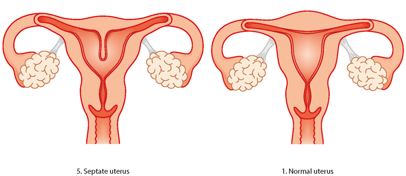 Septate uterus illustration