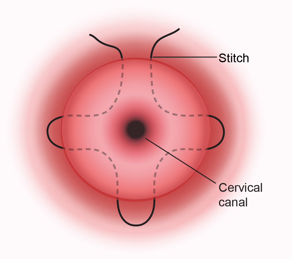 The transvaginal cervical stitch procedure 