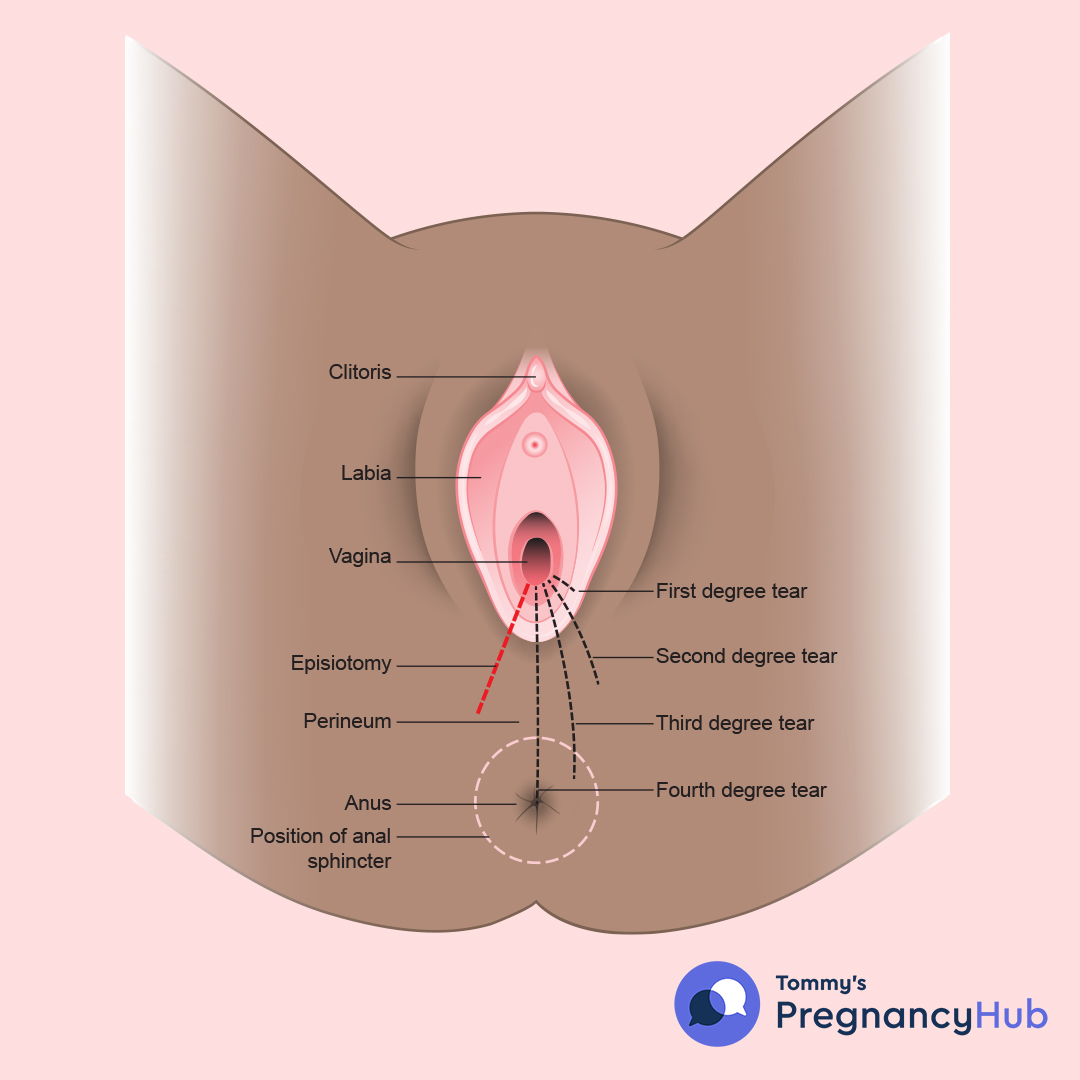 Perineal tears Tommys image