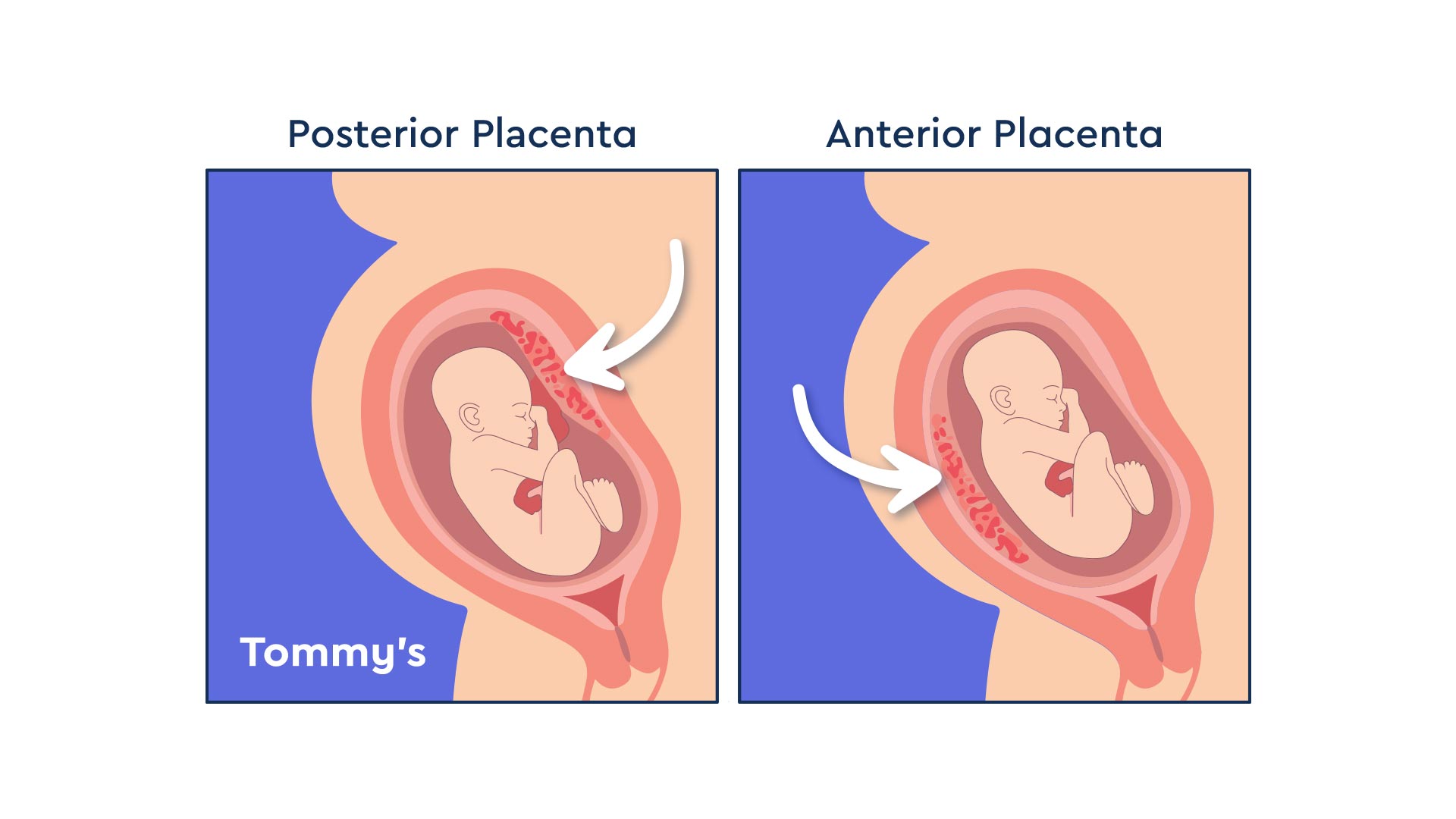 Diagram of an anterior placenta positioning compared to the more usual posterior placenta