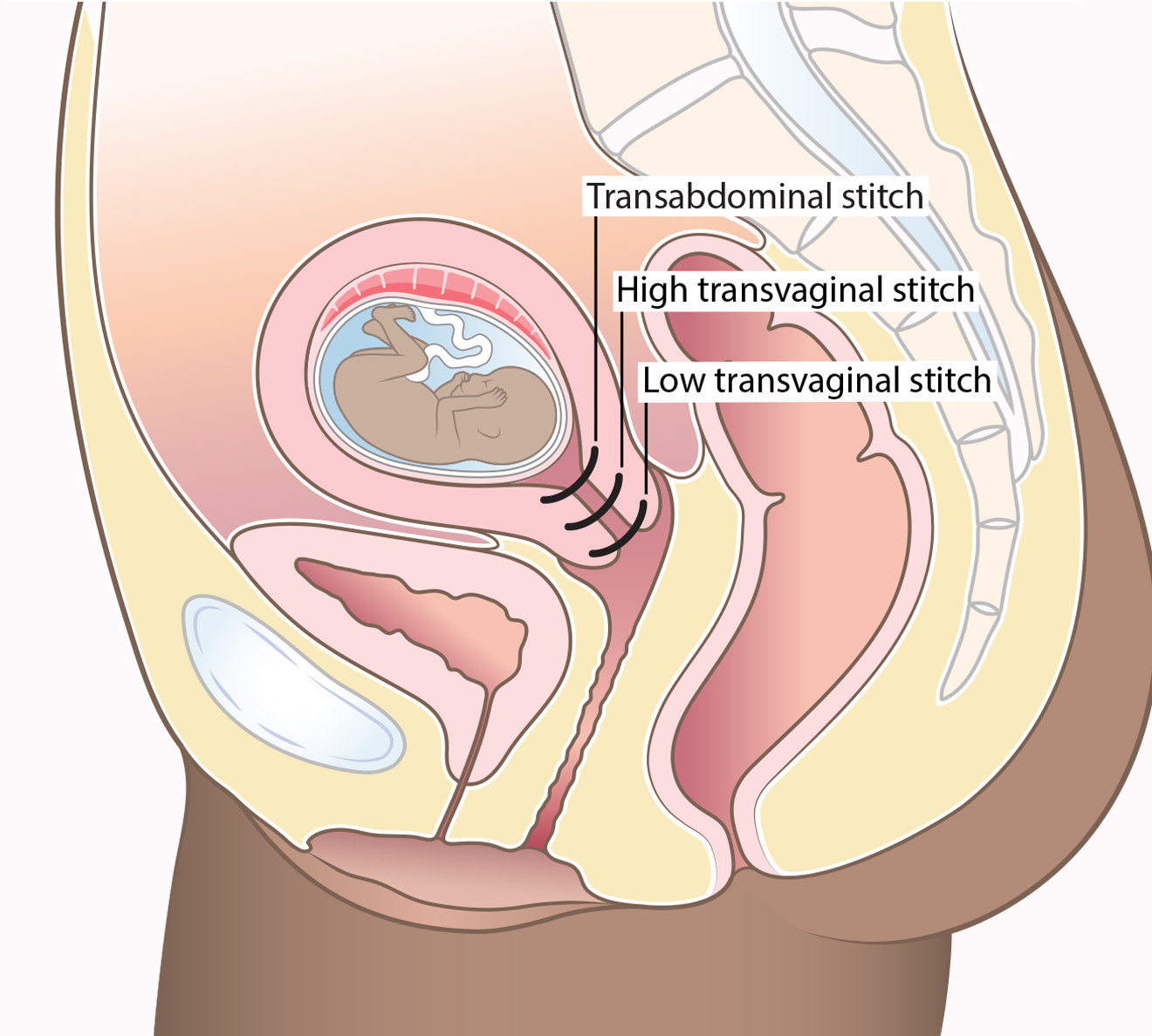 Diagram showing different types of cerclages (stitches) that can be used to reduce the risk of late miscarriage and premature birth.
