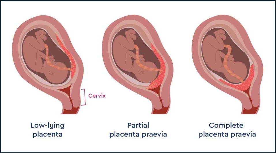 Diagram showing low-lying placenta and placenta praevia