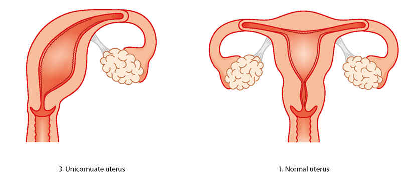 Unicornuate uterus illustration