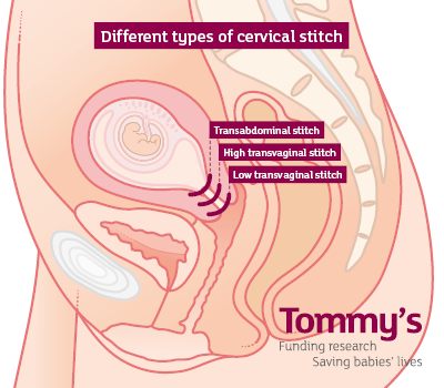 Positioning of vaginal and abdominal cervical stitch to prevent preterm birth