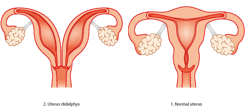 Didelphys uterus illustration